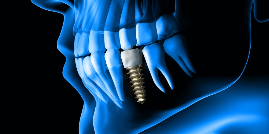 Geheimnisse von Zahnimplantat Schmerzen