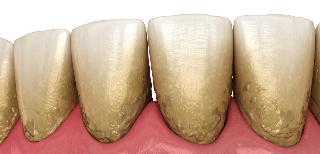 Der Zahnbelag ist ein Biofilm, der nach einer Zeit auf der Oberfläche der Zähne ensteht