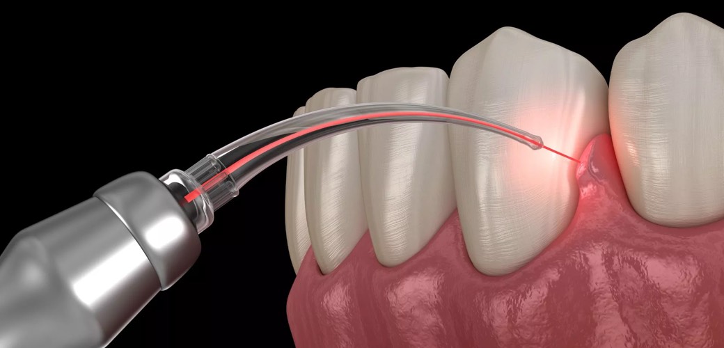 Laserbehandlung der Zahnfleischtaschen