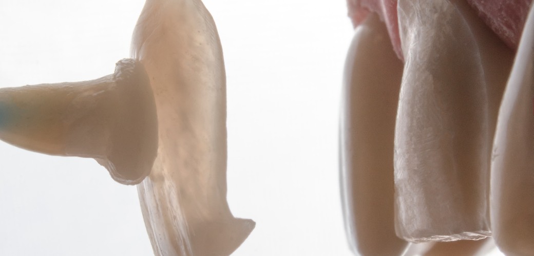 Diese restaurative Behandlung bedeckt die vordere Oberfläche der Zähne