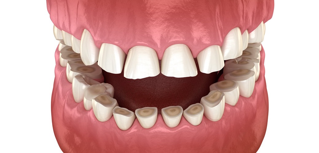 Symptome von Zähneknirschen