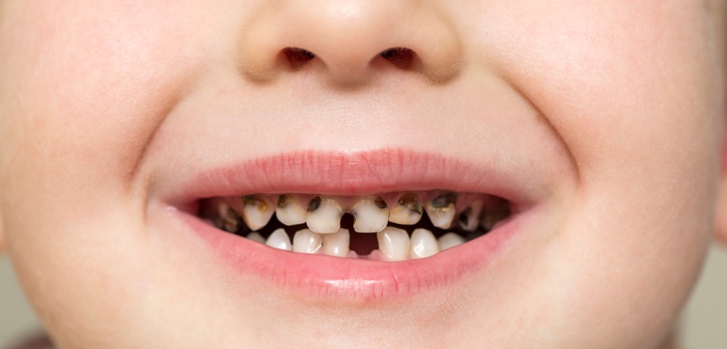 Schon im Kindesalter erscheinen die kariösen Verfärbungen am Zahnhals