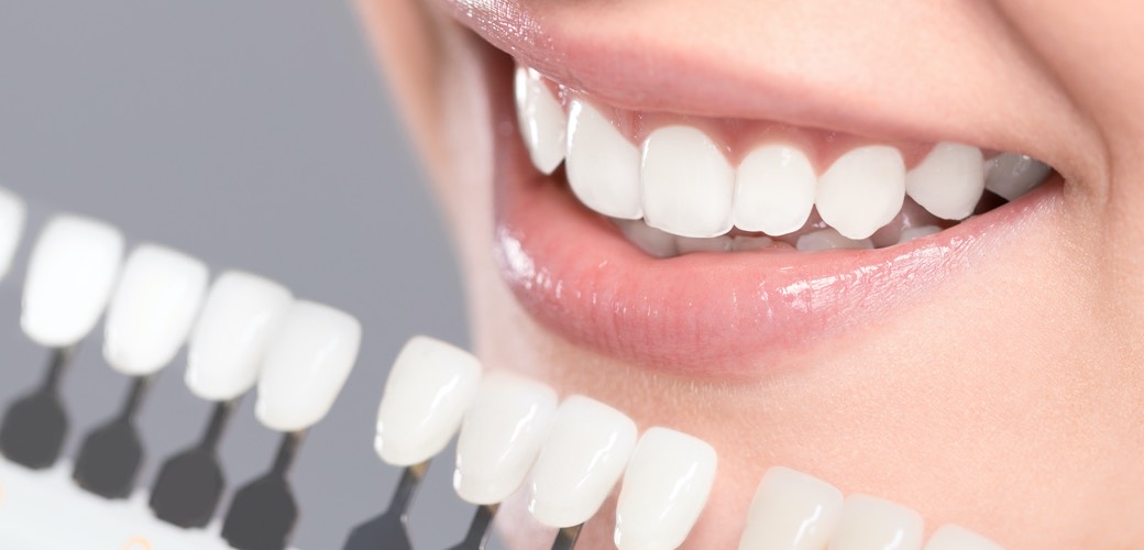 Im Idealfall kann ein Zahn um mehrere Grade aufgehellt werden